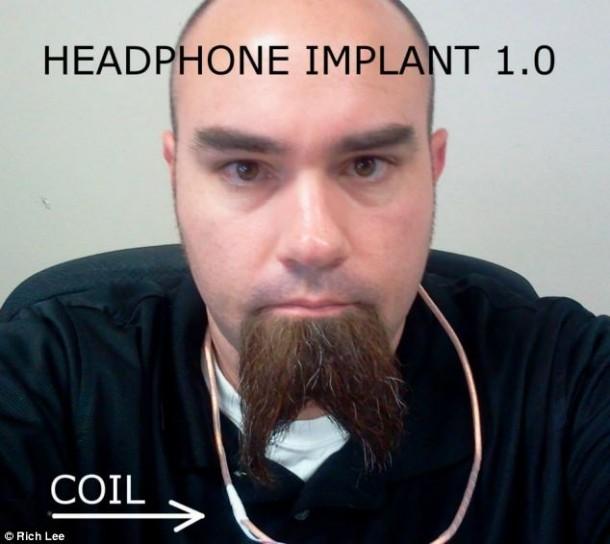 Rich Lee and his implant