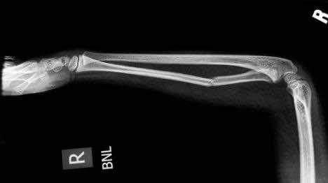 骨愈合骨折腻子