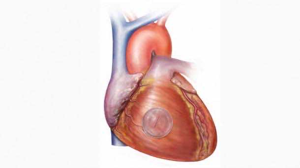 Heart being repaired