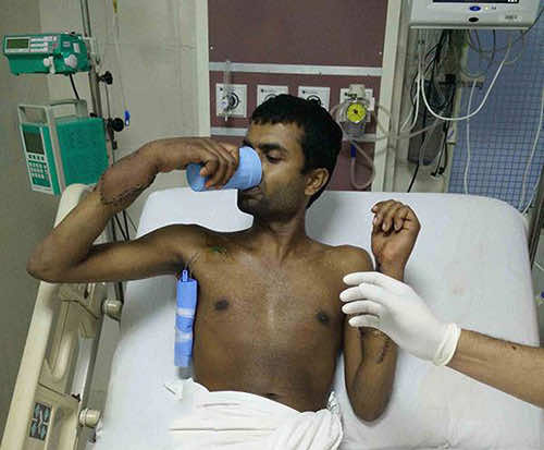 双手移植——现在的现实