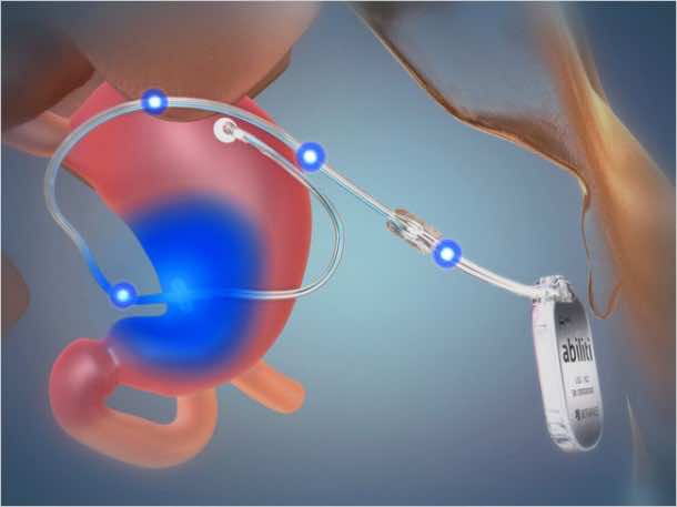 电子帐单控制肥胖2