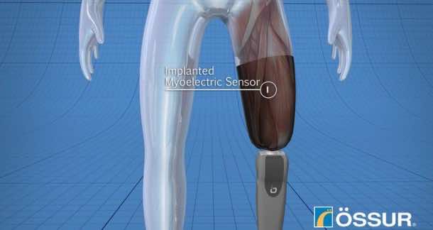 心灵控制的仿生腿假体2