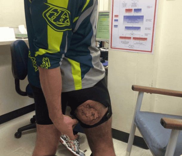 iPhone涉嫌爆炸在他的裤子和左三度烧伤Butt_Image 1