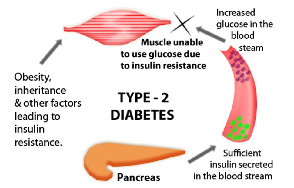 糖尿病2型