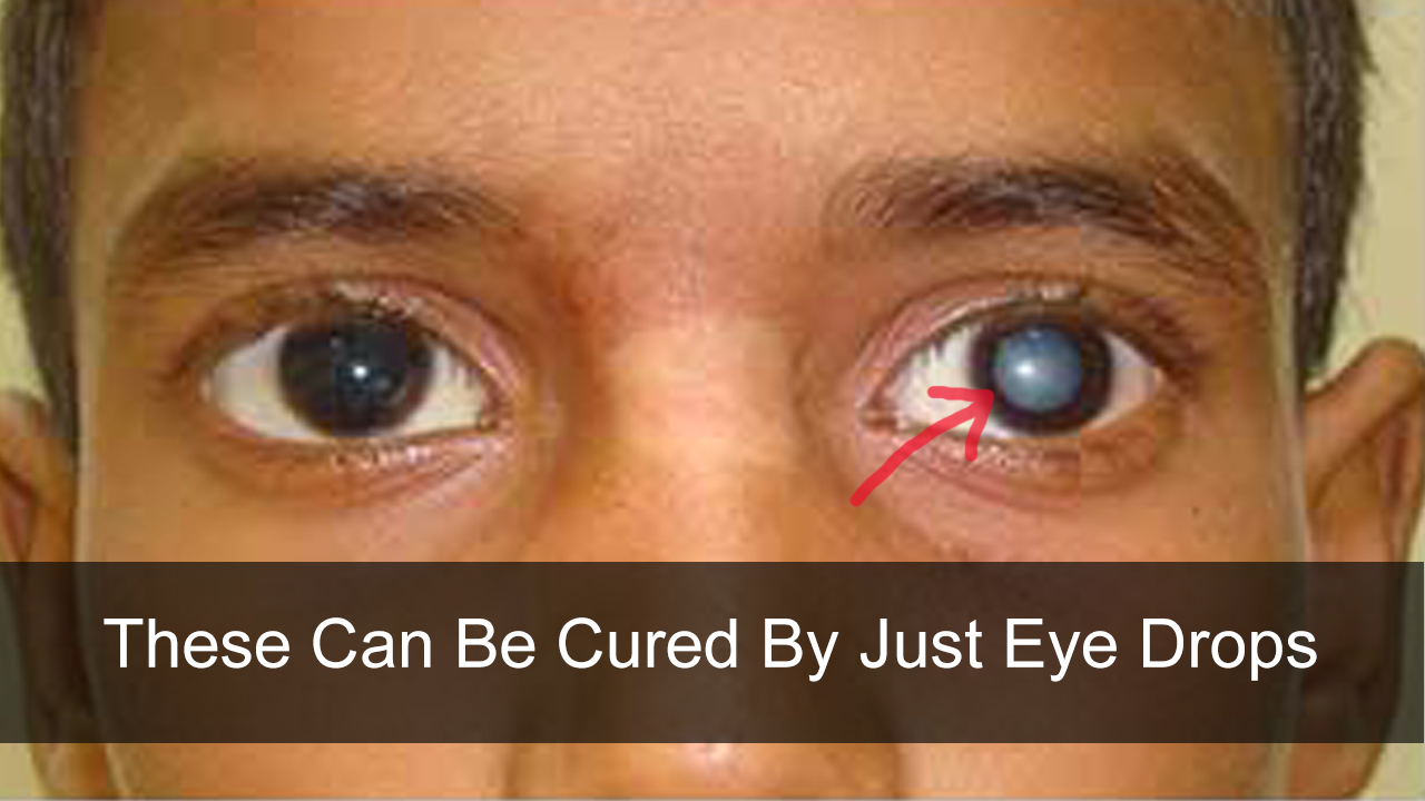 这些眼药水无需手术就能治疗白内障